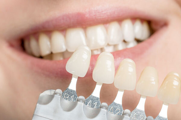 Dental Veneers - McKinney Dentist Dentist in McKinney