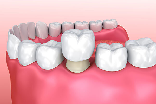 Dental Crowns from the McKinney Dentist at Stonelodge Dental