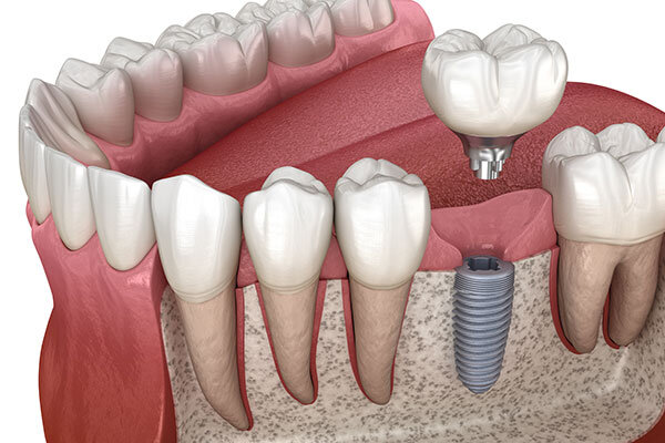 dental implants - McKinney Dentist Dentist in McKinney