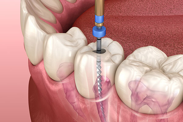Dental Root Canal from the McKinney Dentist at Stonelodge Dental