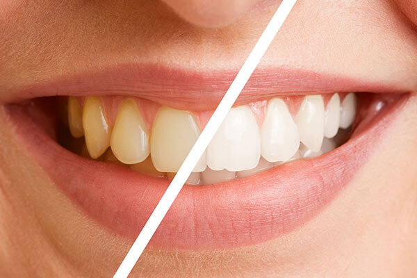 Teeth Whitening - McKinney Dentist Dentist in McKinney