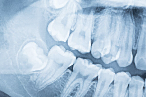 tooth extractions in mckinney