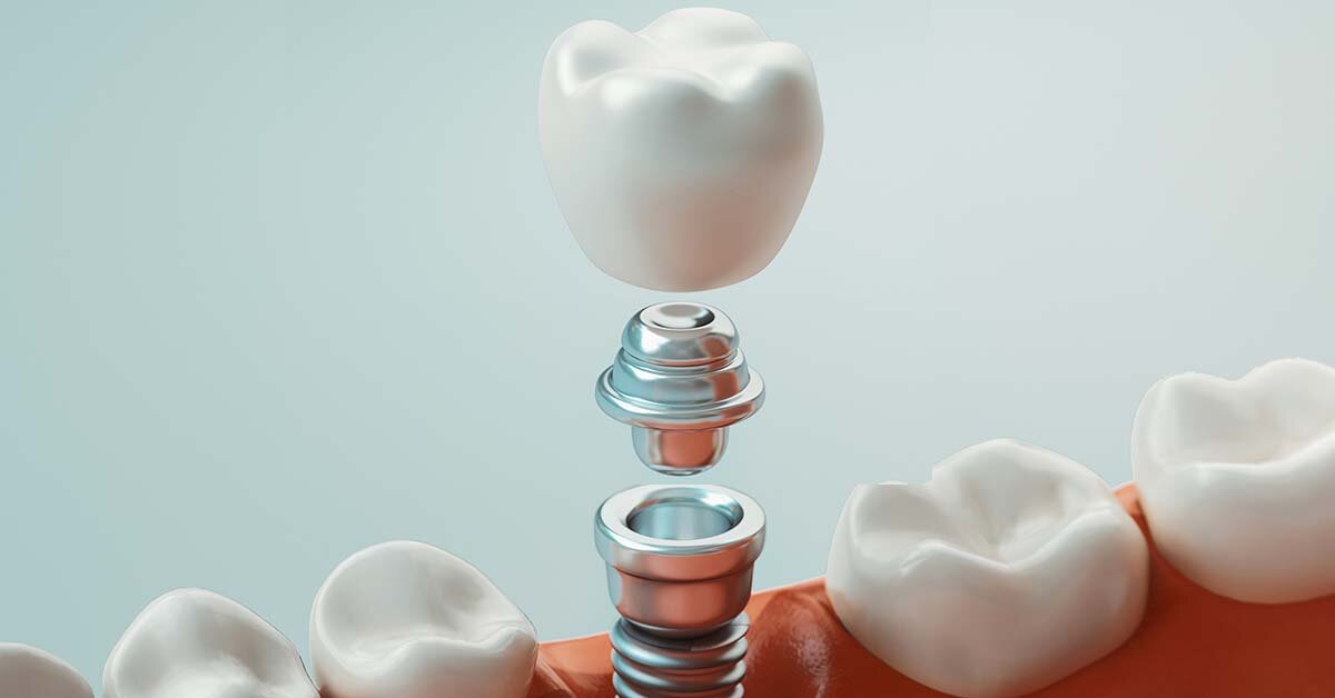 benefits of dental implants - McKinney Dentist Dentist in McKinney