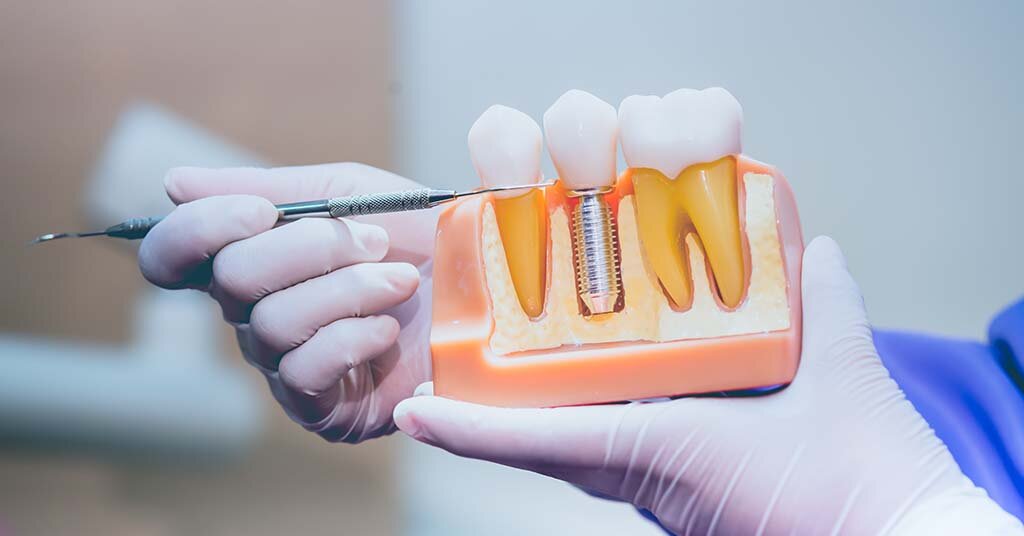 Why Dental Implants are the Best - McKinney Dentist Dentist in McKinney