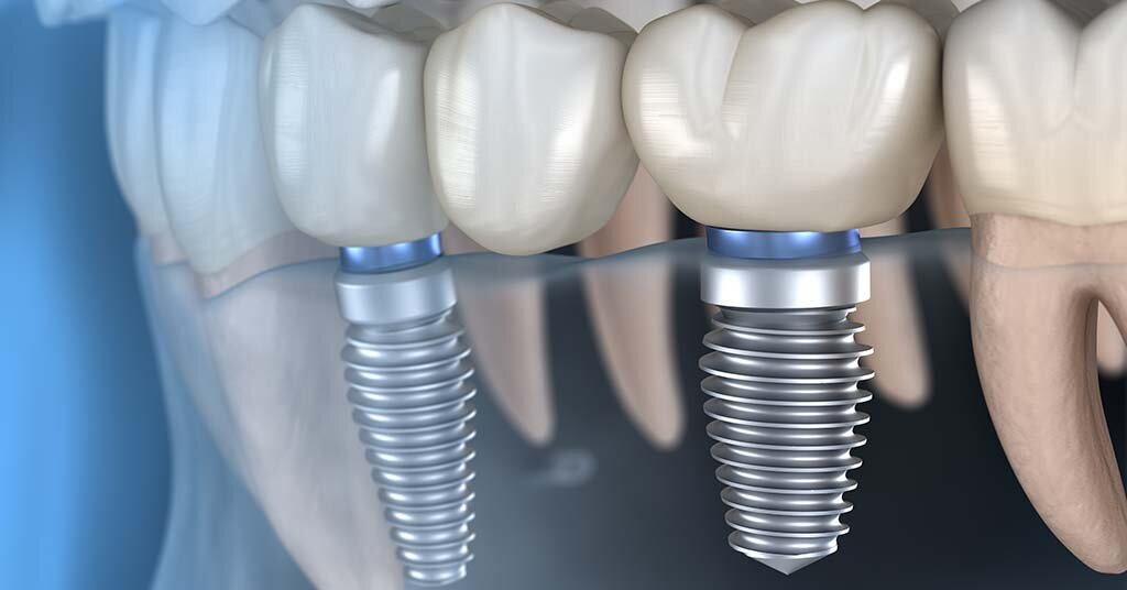 What is the best option for a single tooth replacement?