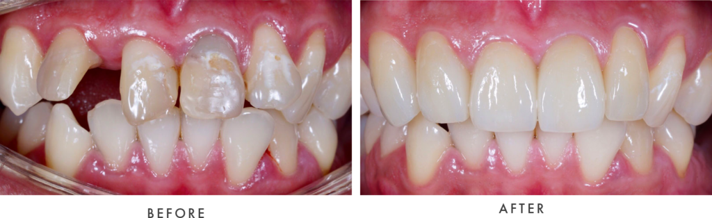 Before and After Photos Dental Implants - McKinney Dentist Dentist in McKinney