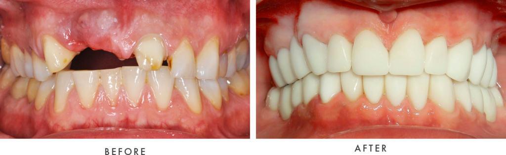 Full mouth Before and After Photos Full Mouth Dental Implants