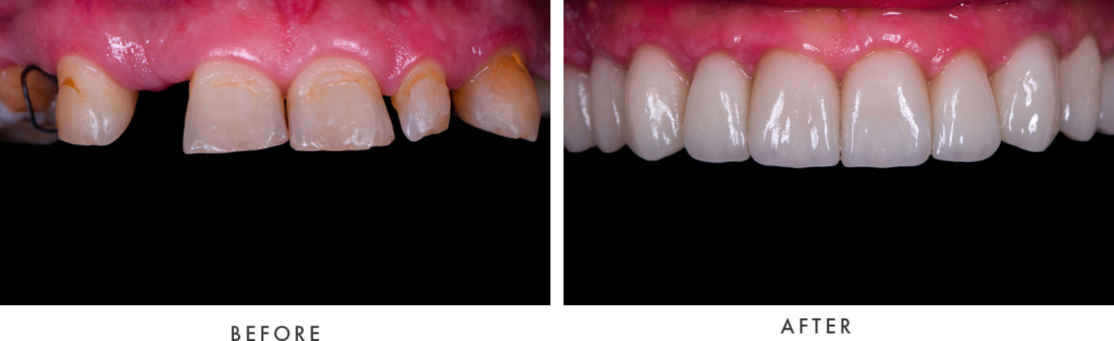 Full Mouth Dental Implants - McKinney Dentist Dentist in McKinney
