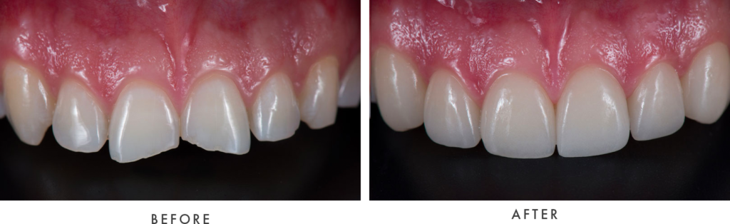 Before and After Photos Porcelain Veneers - McKinney Dentist Dentist in McKinney