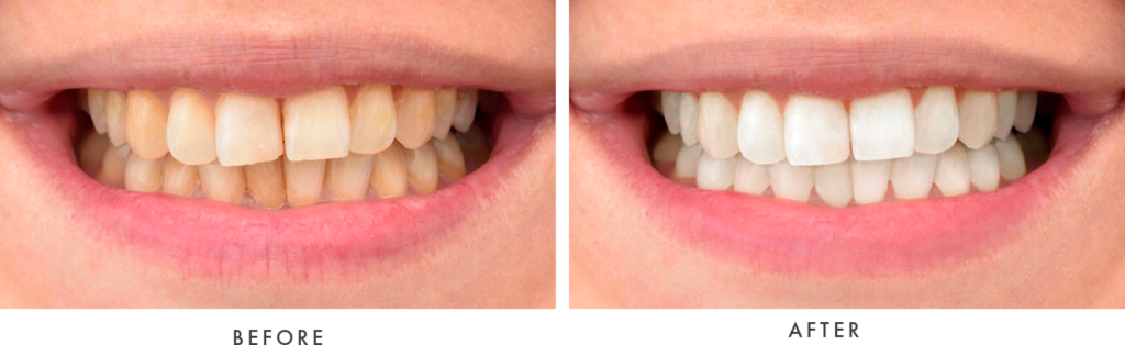 Before and After Photos Professional Teeth Whitening