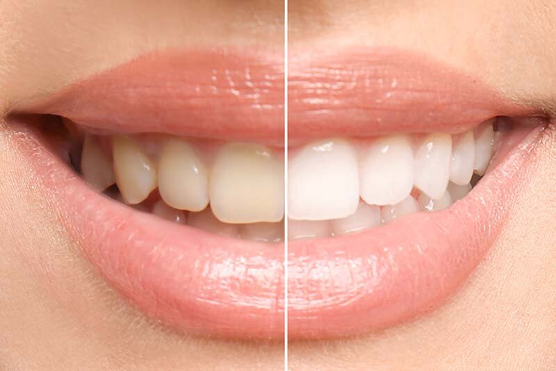 Professional Teeth Whitening in McKinney - McKinney Dentist Dentist in McKinney