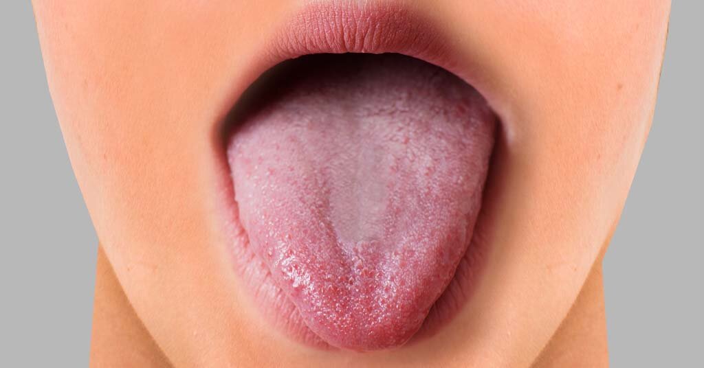 Why do I have Painful Tongue Bumps?
