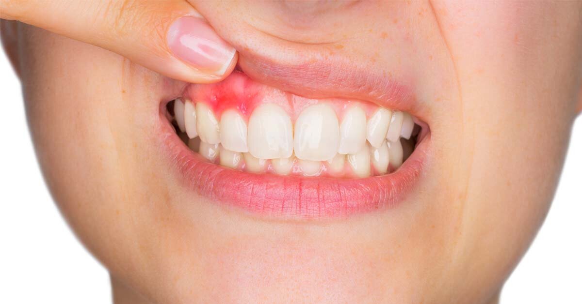 What Causes Inflamed Gums