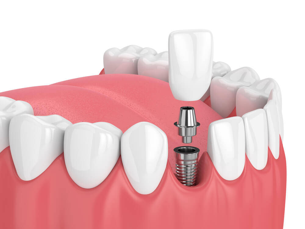 Dentist in McKinney Tx shows you a sample of dental implants