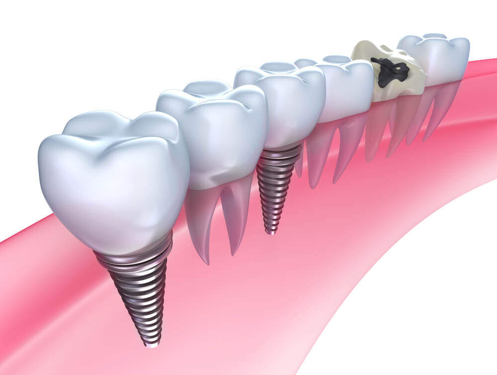 Dental Implants in McKinney Tx sample xray