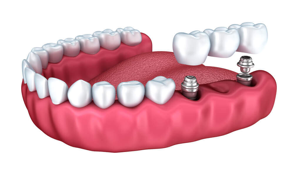 Dental implants by best dentist in mckinney tx