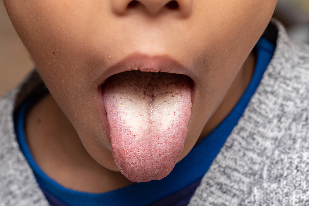 Are Bumps on Back of Tongue Abnormal?