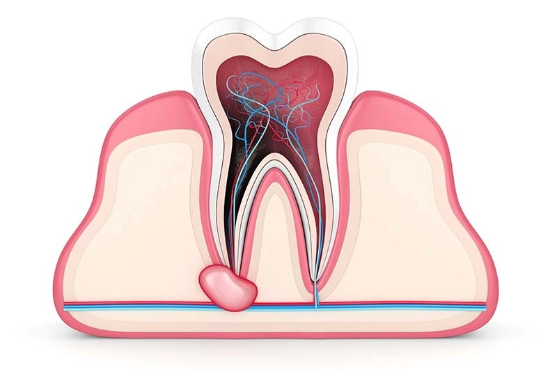 Root Canal Therapy in McKinney - McKinney Dentist Dentist in McKinney, root canal cost