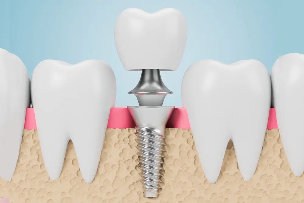 Dental Implants in McKinney Texas, The Best Solution to Tooth Loss, dental implants in mckinney, expert implant dentist, affordable dental implants